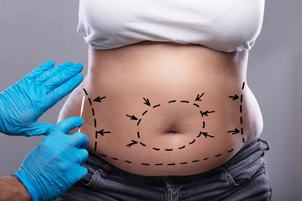 liposuction