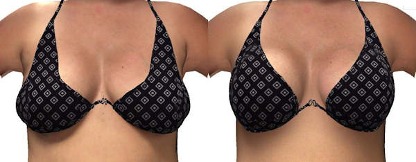 breast-reconstruction