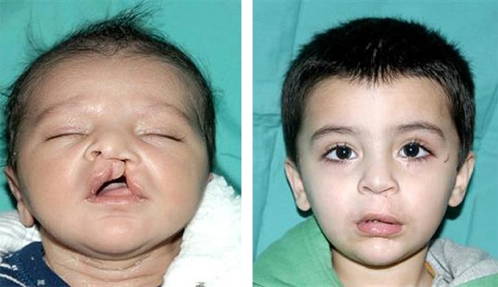 Cleft lip and palate surgery results in Indore by Dr Animesh Damani before after