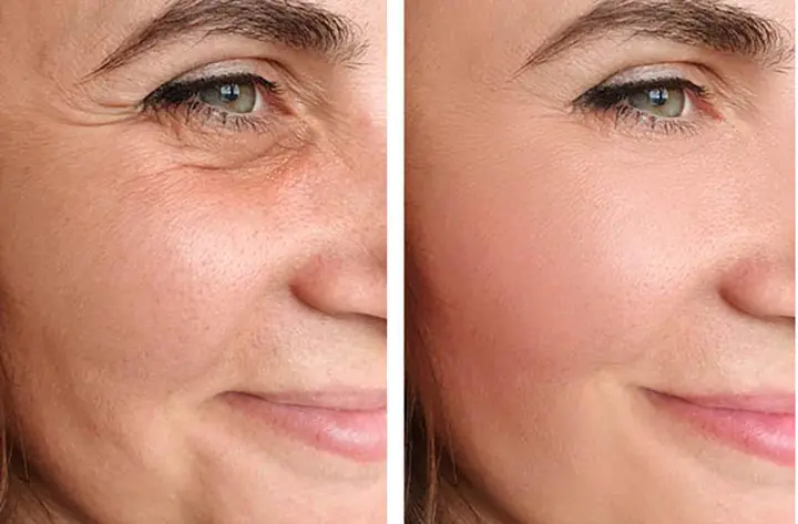 Facelift surgery before and after results showing wrinkle reduction Best Plastic Surgeon in Indore