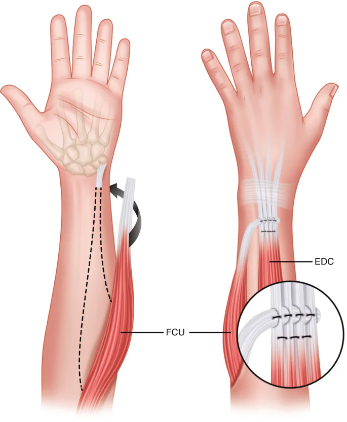 Tendon transfer surgery in Indore by Dr Animesh Damani hand tendon reconstruction