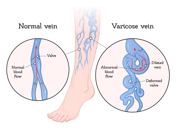 Varicose veins vs normal veins explained by Dr Animesh Damani in Indore