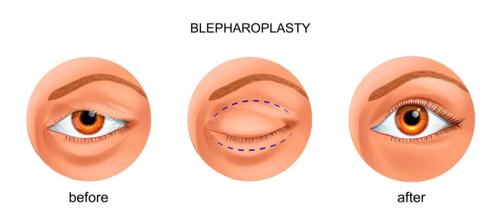 Blepharoplasty eyelid surgery before during and after illustration Best Plastic Surgeon in Indore