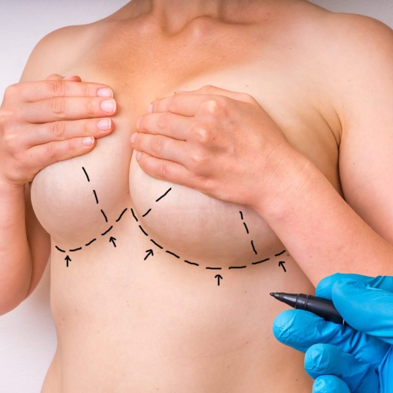 Breast reduction surgery markings before procedure by Dr Animesh Damani Best Plastic Surgeon in Indore