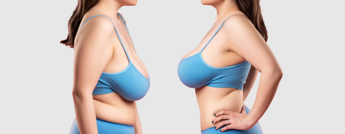 Breast reduction surgery before and after transformation by Dr Animesh Damani Best Plastic Surgeon in Indore