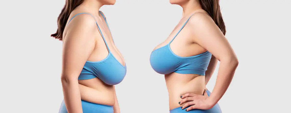 Breast reduction surgery before and after transformation by Dr Animesh Damani Best Plastic Surgeon in Indore