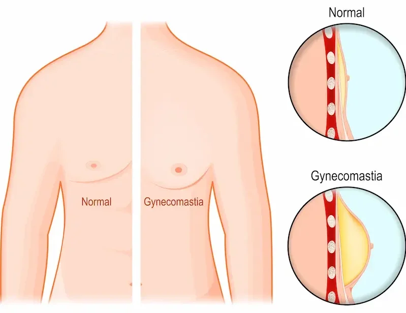 Difference between normal chest and gynecomastia male breast enlargement by Dr Animesh Damani Best Plastic Surgeon in Indore