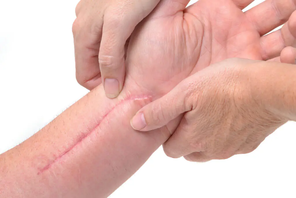 Scar revision surgery in Indore by Dr Animesh Damani arm scar treatment