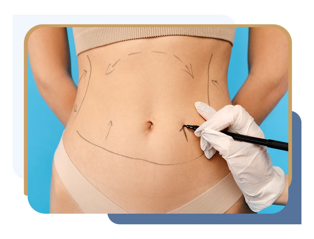 Abdominoplasty tummy tuck surgery marking on abdomen by Dr Animesh Damani Best Plastic Surgeon in Indore