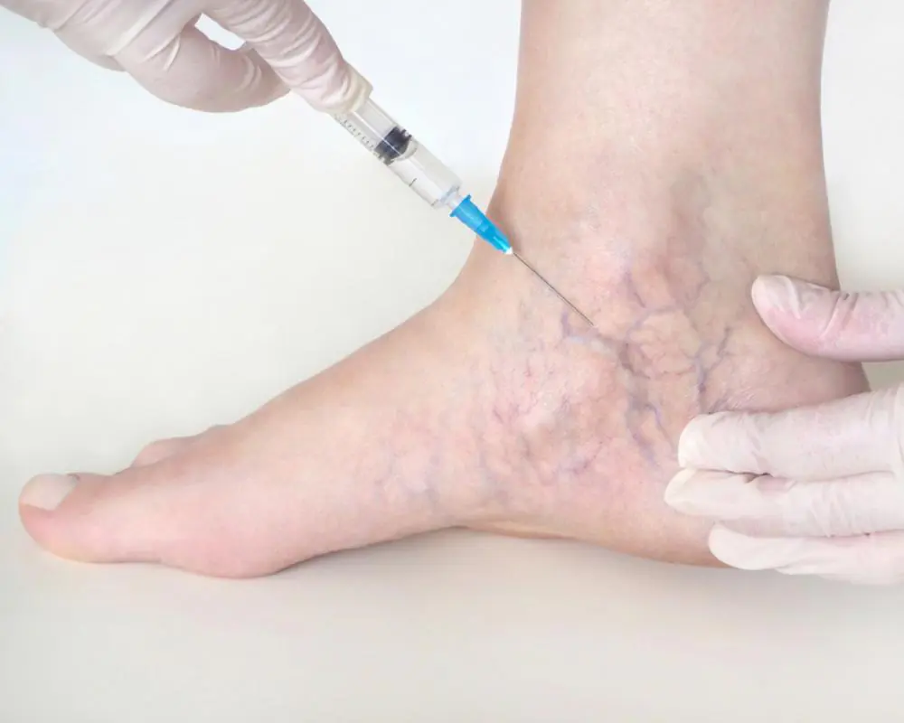 Varicose veins treatment in Indore by Dr Animesh Damani best plastic surgeon sclerotherapy procedure