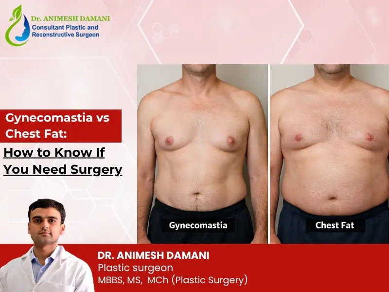 Gynecomastia vs chest fat comparison with surgical guidance by Dr Animesh Damani Best Plastic Surgeon in Indore
