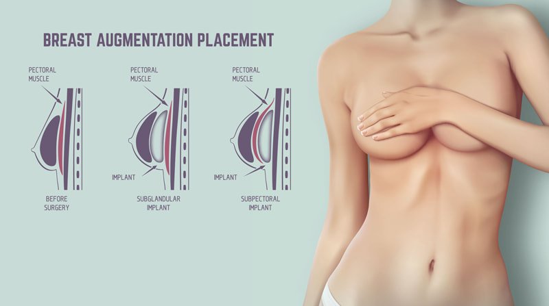 Breast augmentation implant placement types subglandular and submuscular by Dr Animesh Damani Best Plastic Surgeon in Indore