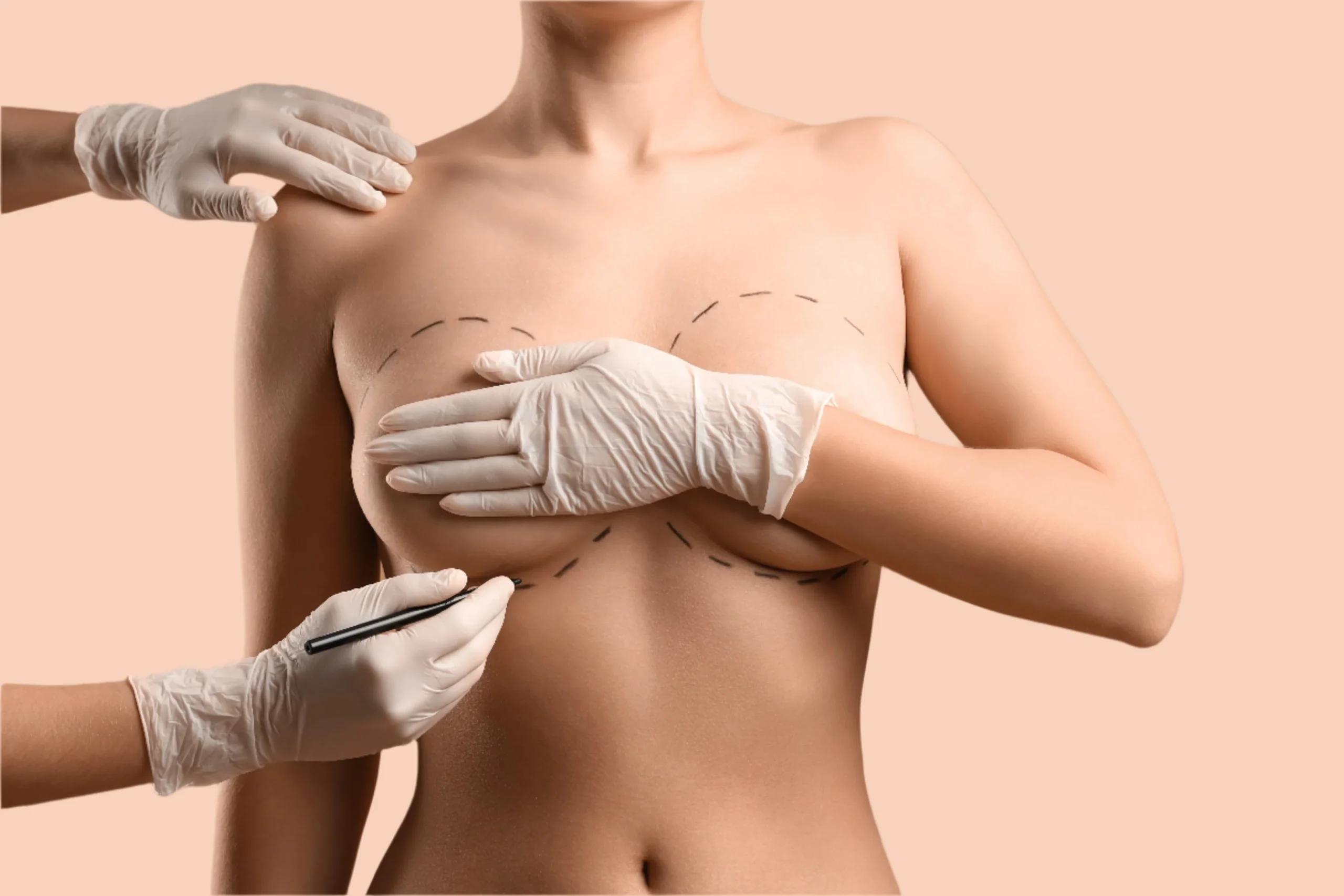 Breast augmentation surgery planning with marking by Dr Animesh Damani Best Plastic Surgeon in Indore