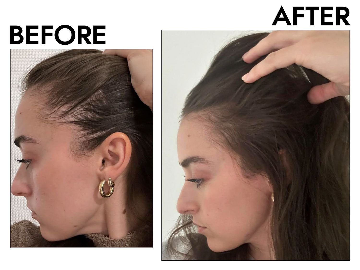 Hair growth treatment before and after results showing improved hair density by Dr Animesh Damani Best Plastic Surgeon in Indore