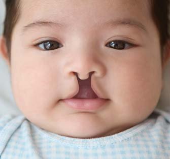 Cleft lip condition in baby treated by Dr Animesh Damani in Indore