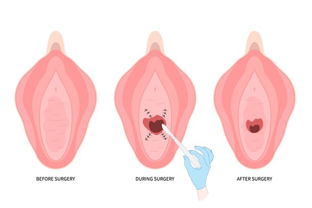 Cosmetic gynecology surgery process showing before during and after results by Dr Animesh Damani Best Plastic Surgeon in Indore