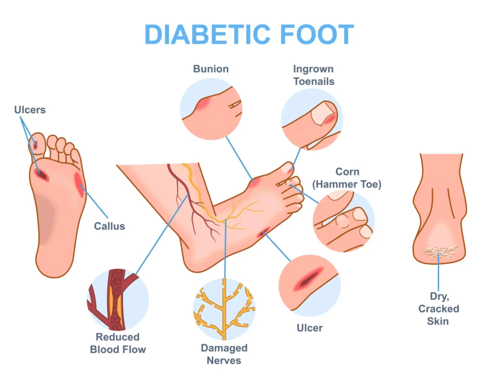 Diabetic foot problems and treatment in Indore by Dr Animesh Damani