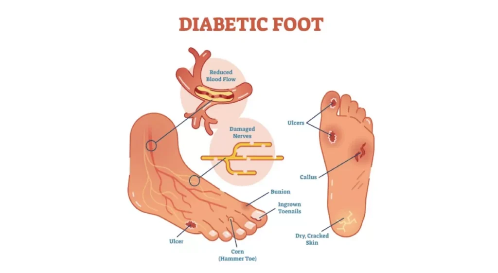 Diabetic foot complications and treatment in Indore by Dr Animesh Damani