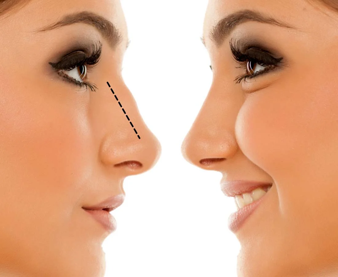 Rhinoplasty before and after nose shape correction by Dr Animesh Damani Best Plastic Surgeon in Indore