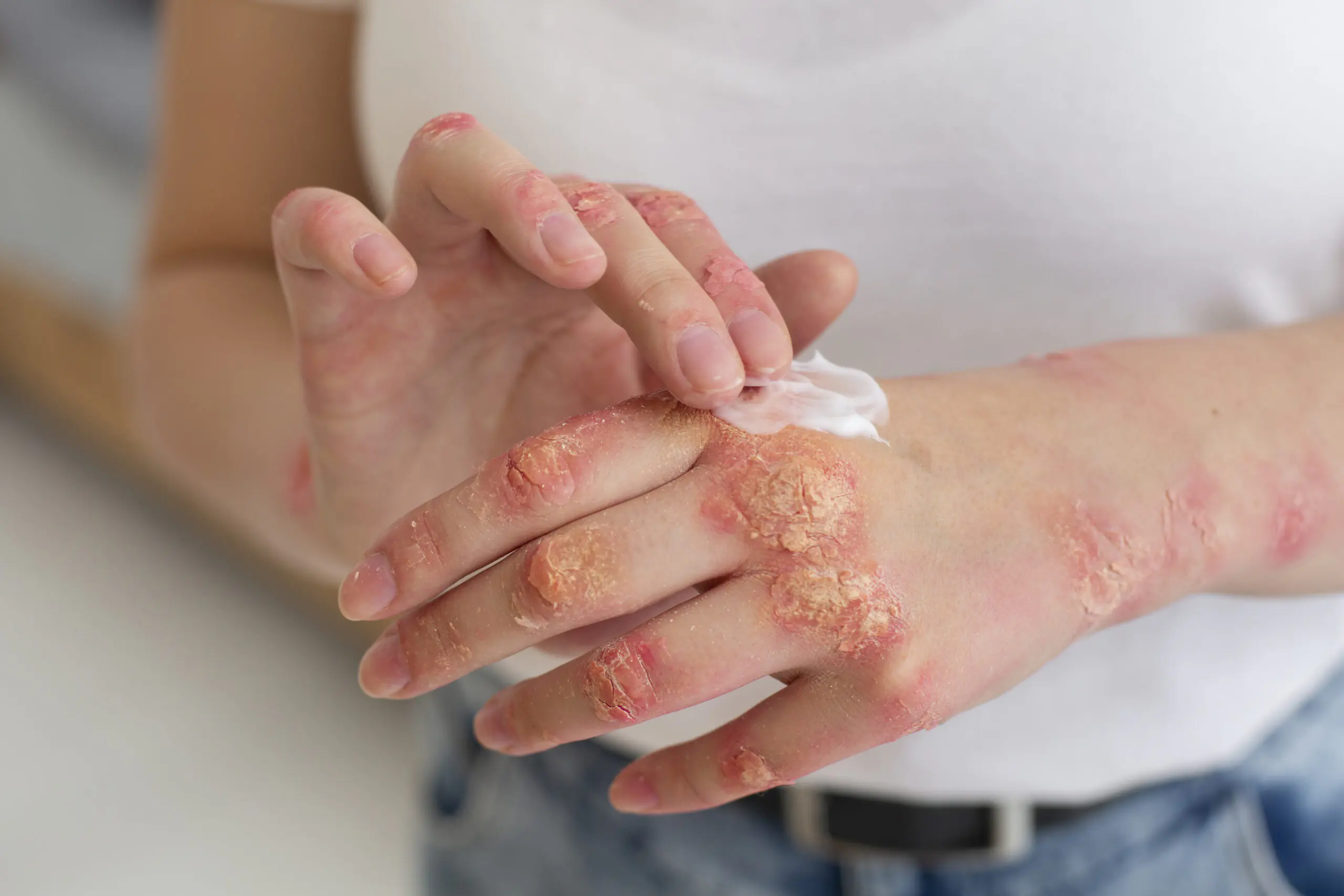Severe hand burn injury treatment with cream application Best Plastic Surgeon in Indore