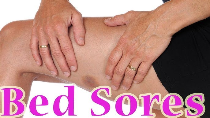 Bed sores treatment in Indore by Dr Animesh Damani for pressure ulcer care