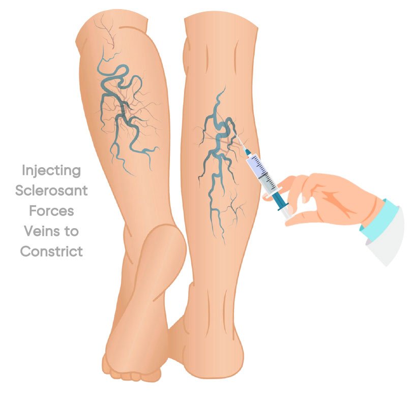 Varicose veins treatment in Indore by Dr Animesh Damani sclerotherapy procedure