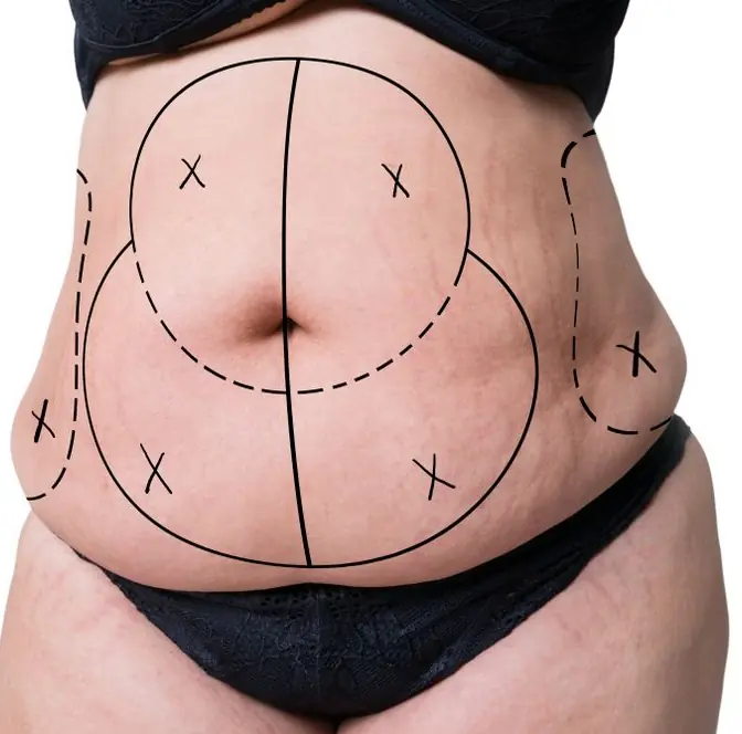 Onco reconstruction surgery in Indore by Dr Animesh Damani abdominal reconstruction procedure