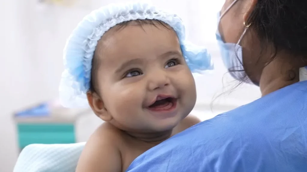 Cleft lip and palate surgery in Indore by Dr Animesh Damani pediatric treatment