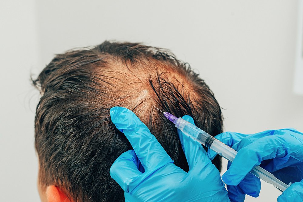 PRP hair growth treatment with scalp injection therapy for hair loss by Dr Animesh Damani Best Plastic Surgeon in Indore