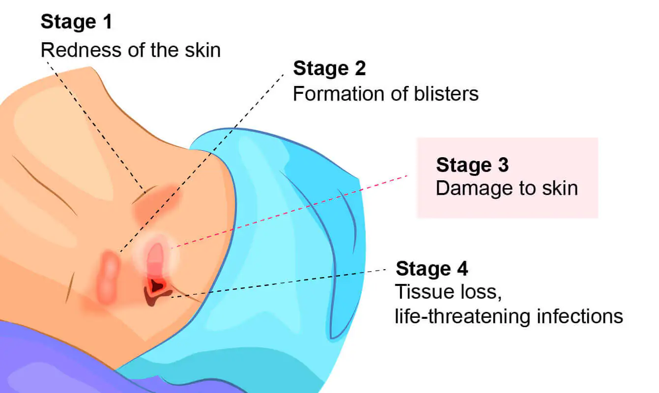 Bed sores treatment in Indore by Dr Animesh Damani plastic surgeon stages of pressure ulcers