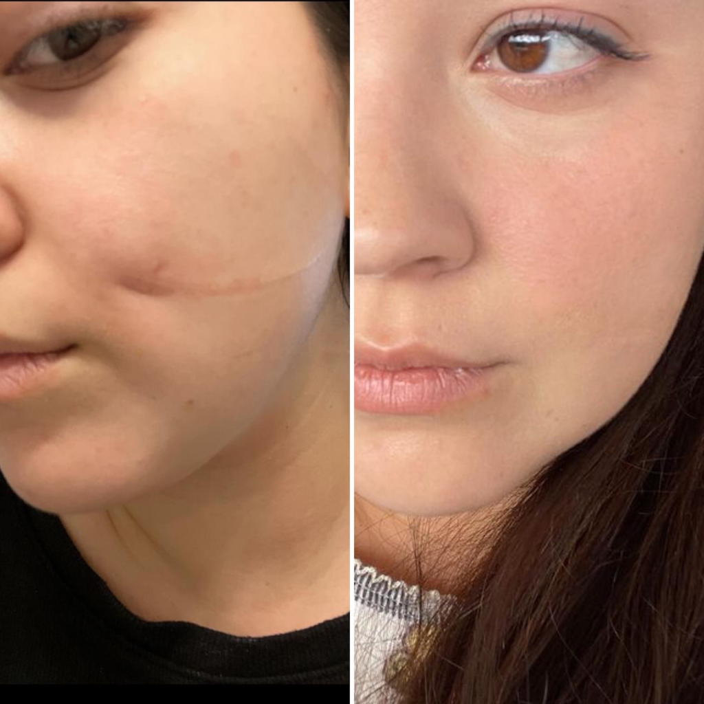 Scar revision surgery results in Indore by Dr Animesh Damani facial scar treatment before after