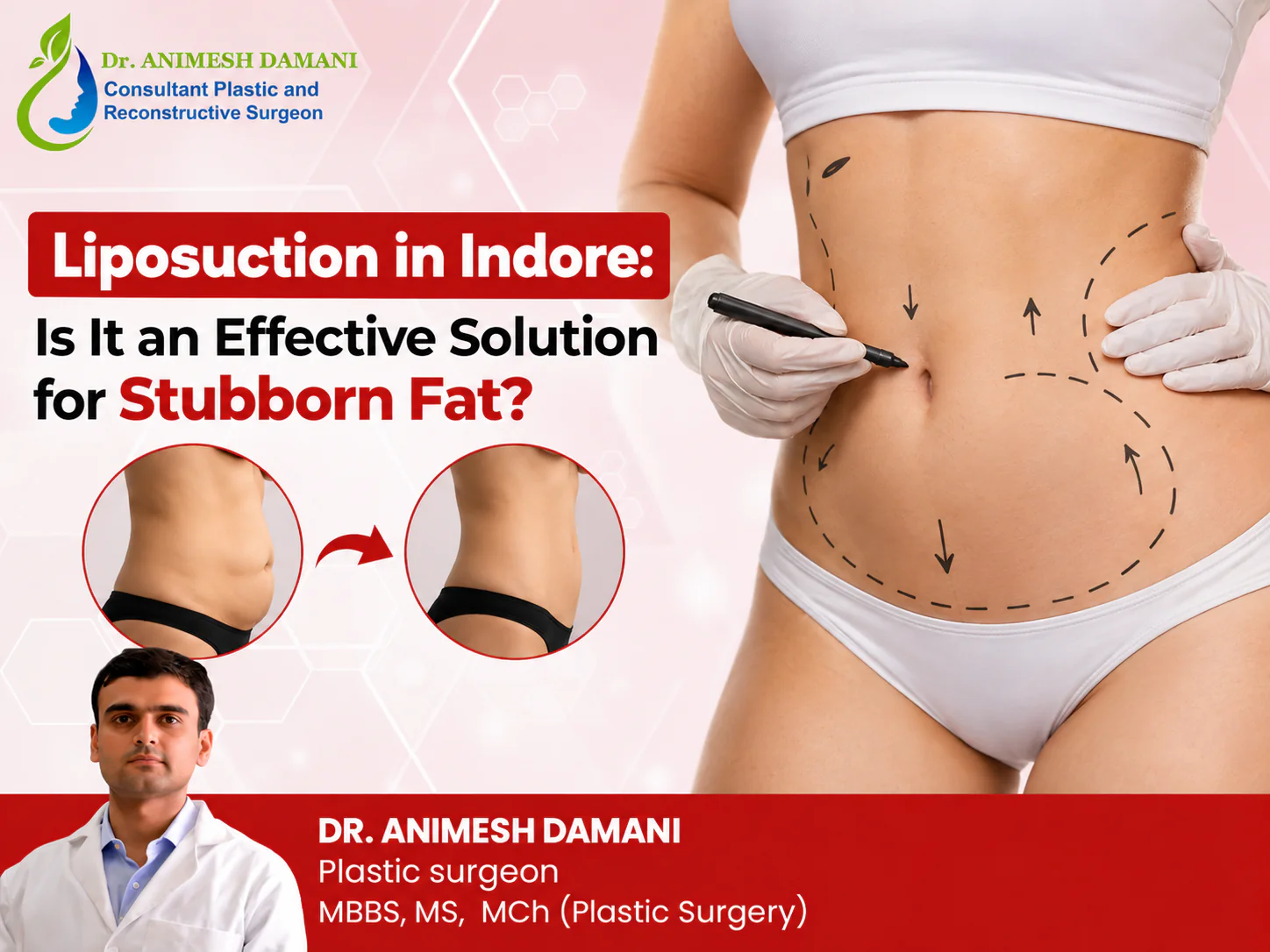 Liposuction in Indore for stubborn fat with abdominal contouring and body shaping